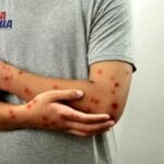 Alerta em Carinhanha: vários estudantes são afastados após diagnóstico de catapora